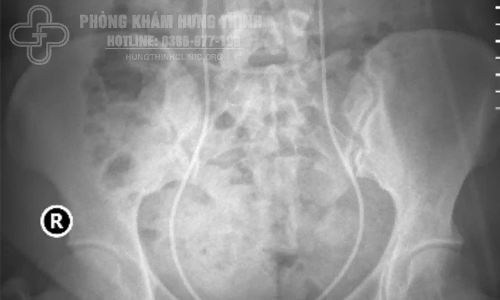 Hình ảnh Xquang sau thực hiện hai kỹ thuật tán sỏi