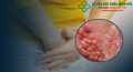 Bị bệnh sùi mào gà có thể chữa khỏi hẳn được không?