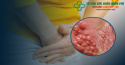 Bị bệnh sùi mào gà có thể chữa khỏi hẳn được không?